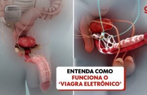 Viagra eletrônico: aparelho de fabricação brasileira restaura ereções em 90% dos pacientes do estudo