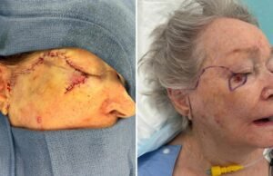 ‘O medo é pior que o câncer’: a batalha pela saúde mental do sobrevivente do carcinoma de células da pálpebra Merkel em meio à morte do marido