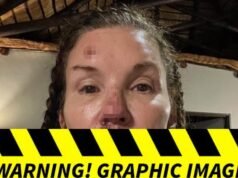 Fotos dos supostos ferimentos de Janice Dickinson em queda fatal em ‘I’m a Celebrity’