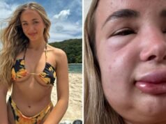 Gabby Gosling: influenciadora australiana sofre reação alérgica grave após a dissolução do preenchimento labial