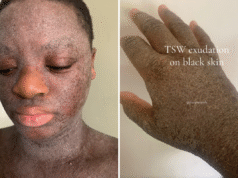 A mulher recebeu esteróides quando criança – agora ela enfrenta uma condição dolorosa