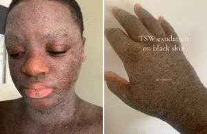 A mulher recebeu esteróides quando criança – agora ela enfrenta uma condição dolorosa