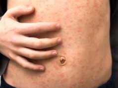 Grande surto de sarampo afeta crianças menores de 10 anos em Londres