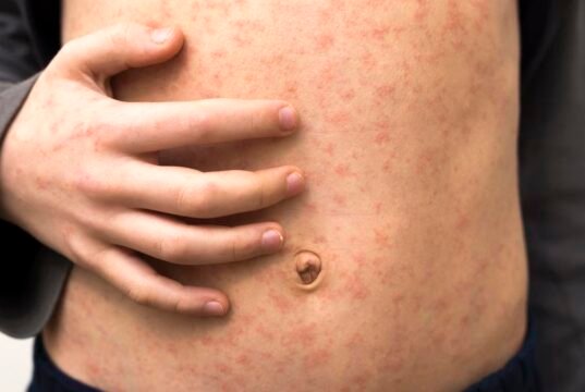 Grande surto de sarampo afeta crianças menores de 10 anos em Londres