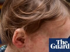 Sarampo: como se espalha e como posso proteger meu filho? | doença infecciosa