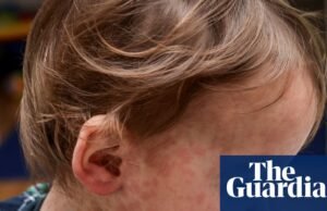 Sarampo: como se espalha e como posso proteger meu filho? | doença infecciosa