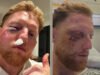 Ben Stokes passa por uma cirurgia facial após choque na rede, capitão da Inglaterra compartilha foto