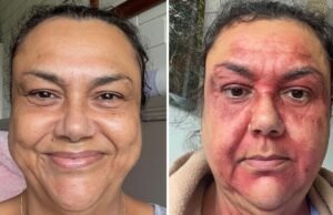 Especialistas alertam que problemas graves de pele estão aumentando devido aos extremos climáticos