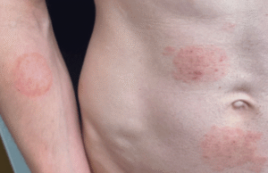 O herpes sexualmente transmissível está aumentando em um estado dos EUA