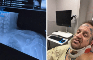 Jelly Roll estava no Grammy com uma clavícula quebrada devido a um acidente de quadriciclo, coelho posta vídeo