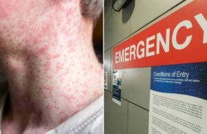 NSW Health confirma caso de sarampo no oeste de Sydney sem fonte conhecida